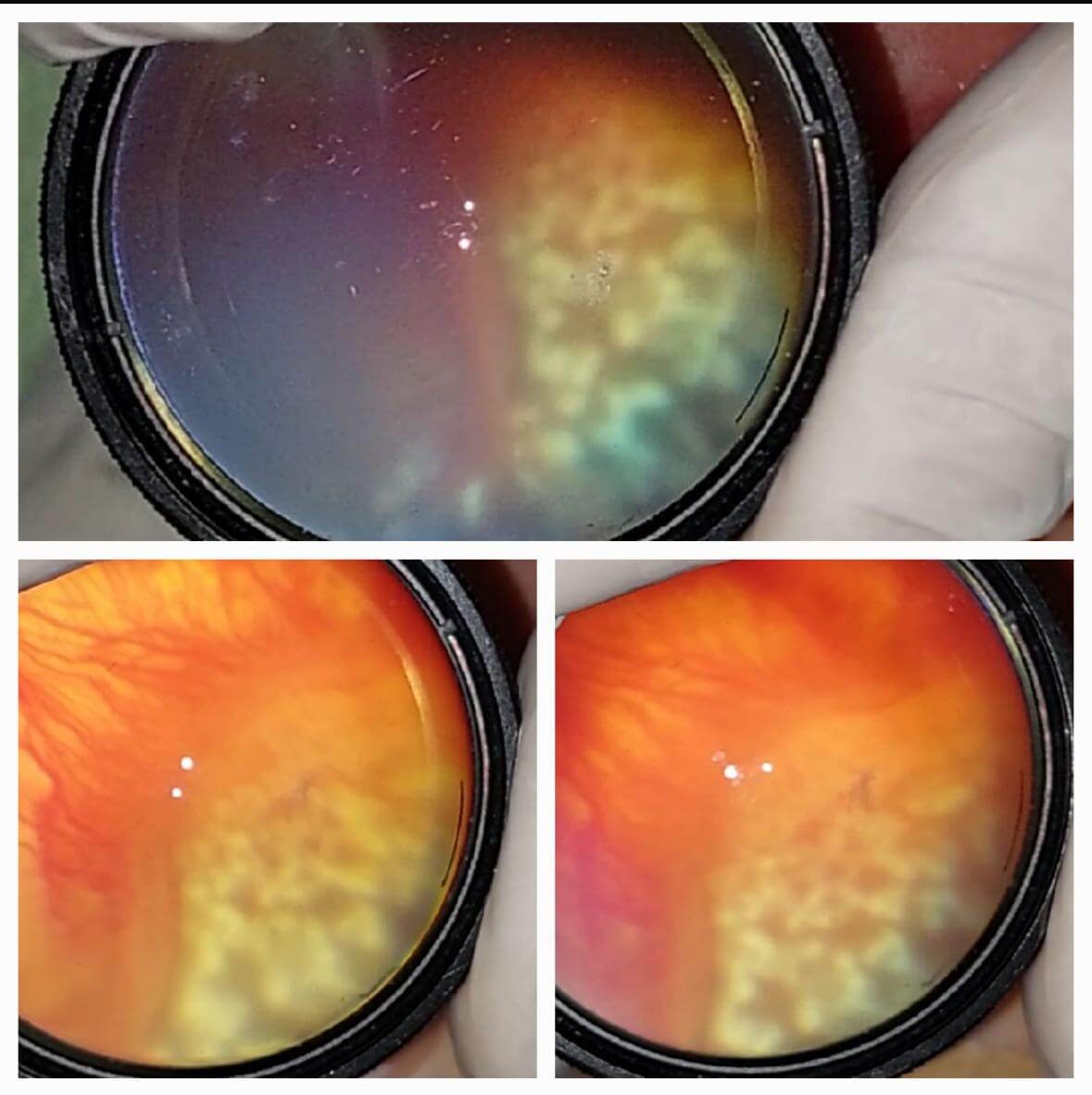 retinopatía prematuro